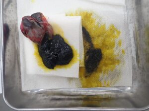 胆のう粘液嚢腫